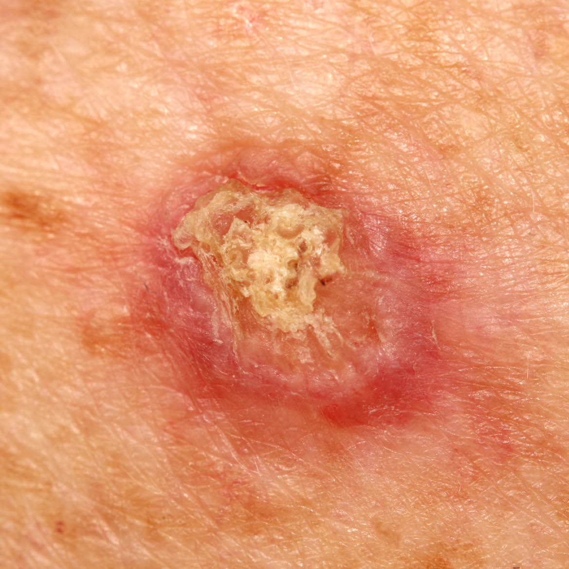 Early Squamous Cell Carcinoma Early Squamous Cell Carcinoma