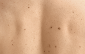 mole mapping