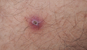 BASAL CELL CARCINOMA