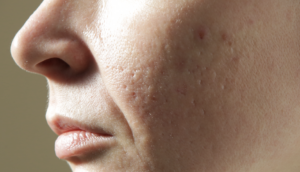 ACNE scars treatment London