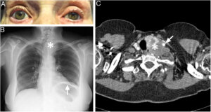 Rowland Payne Syndrome