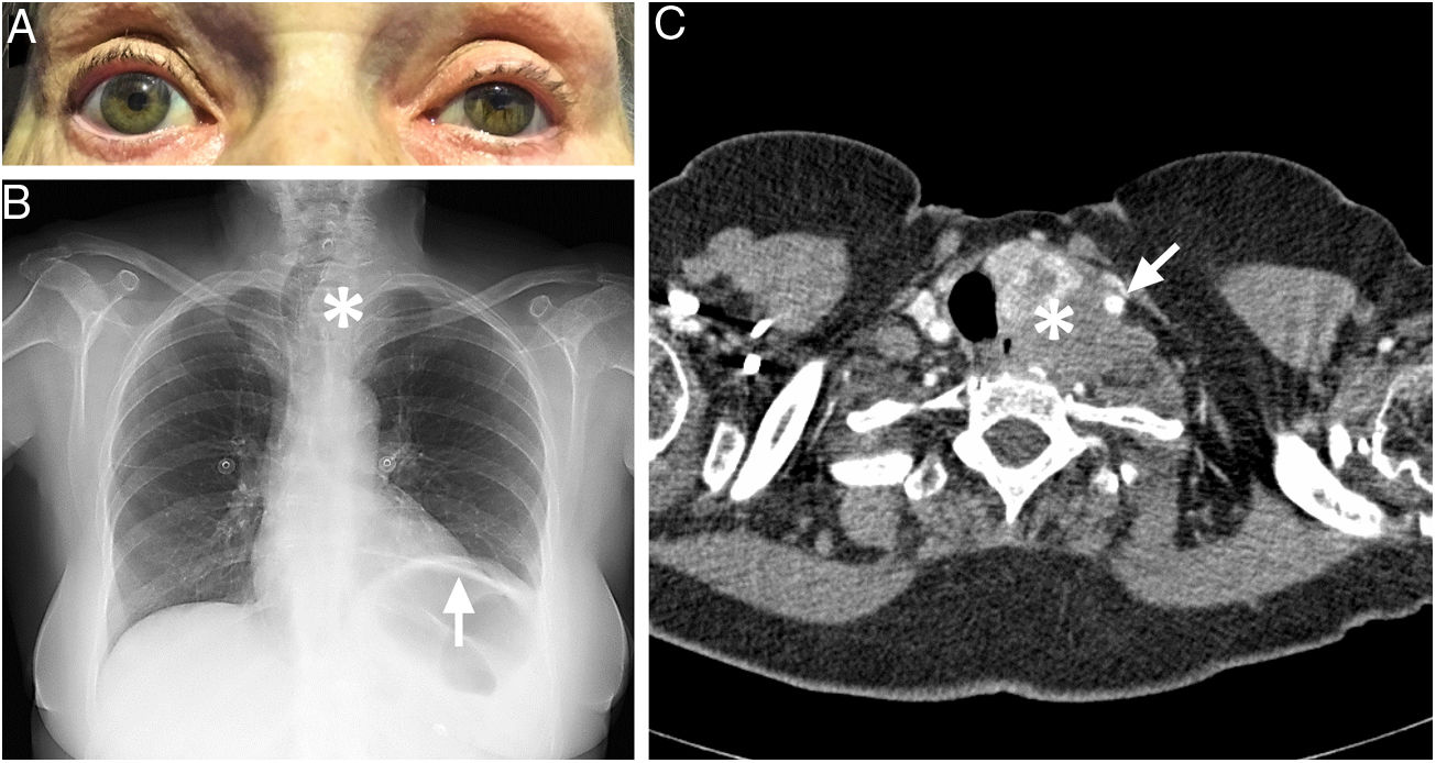Rowland Payne Syndrome